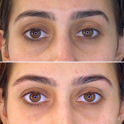 botox filler pioneers lasts unlike brow uptown